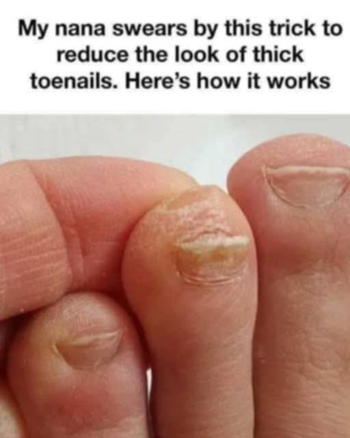 ه My nana swears by this trick to reduce the look of thick toenails. Here’s how it works