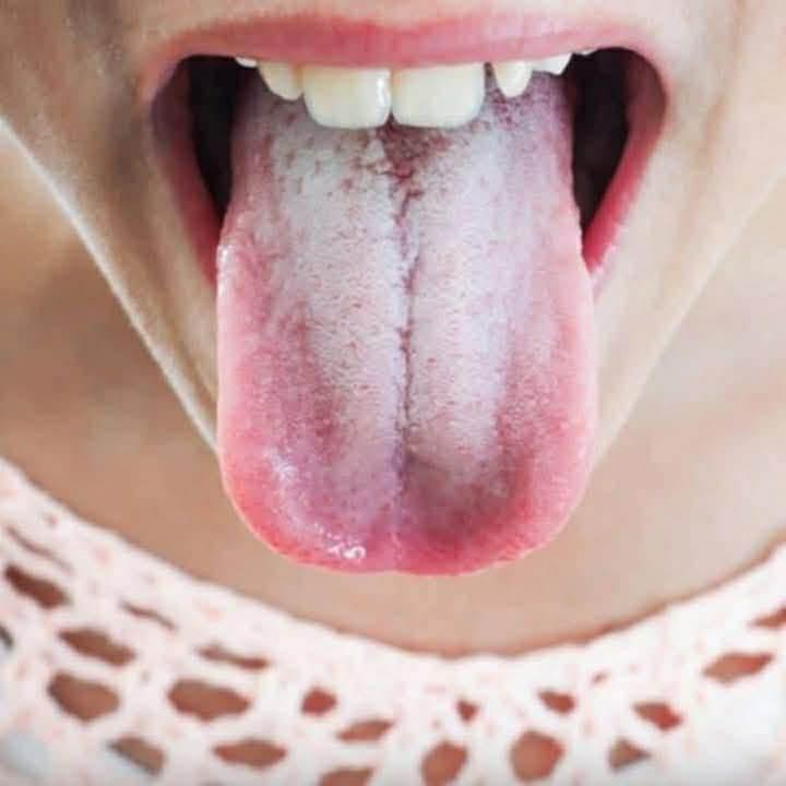 🚨😳 If your tongue is white, this is a clear sign that you are suffering from…See more