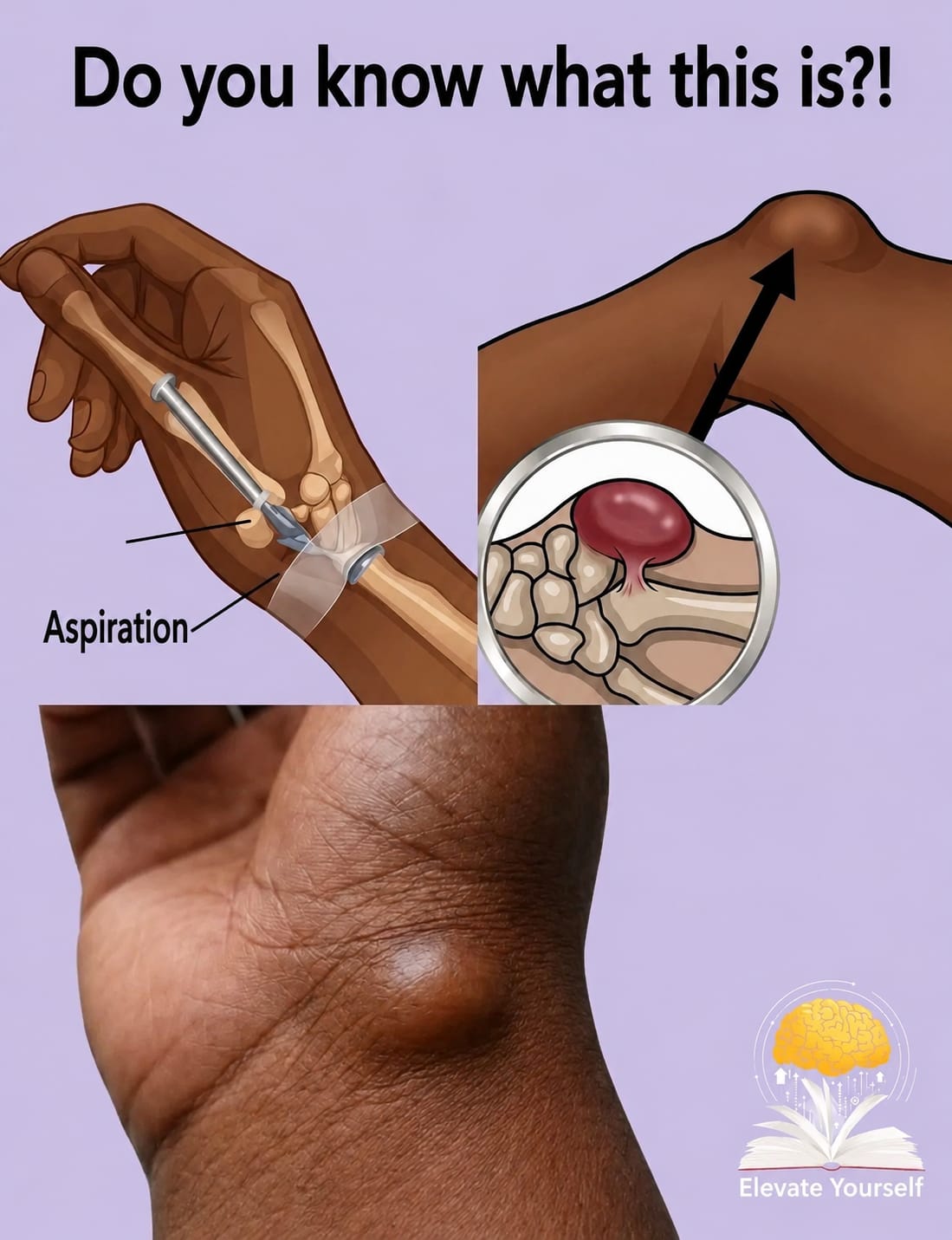 🖐️ 5 Things You Should Know Before Touching a Lump on Your Wrist!