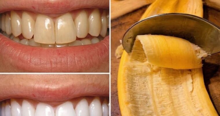 Secret Dentists They Don’t Want You to Meet: Removes Tartar and Whitens Teeth in Just 2 Minutes