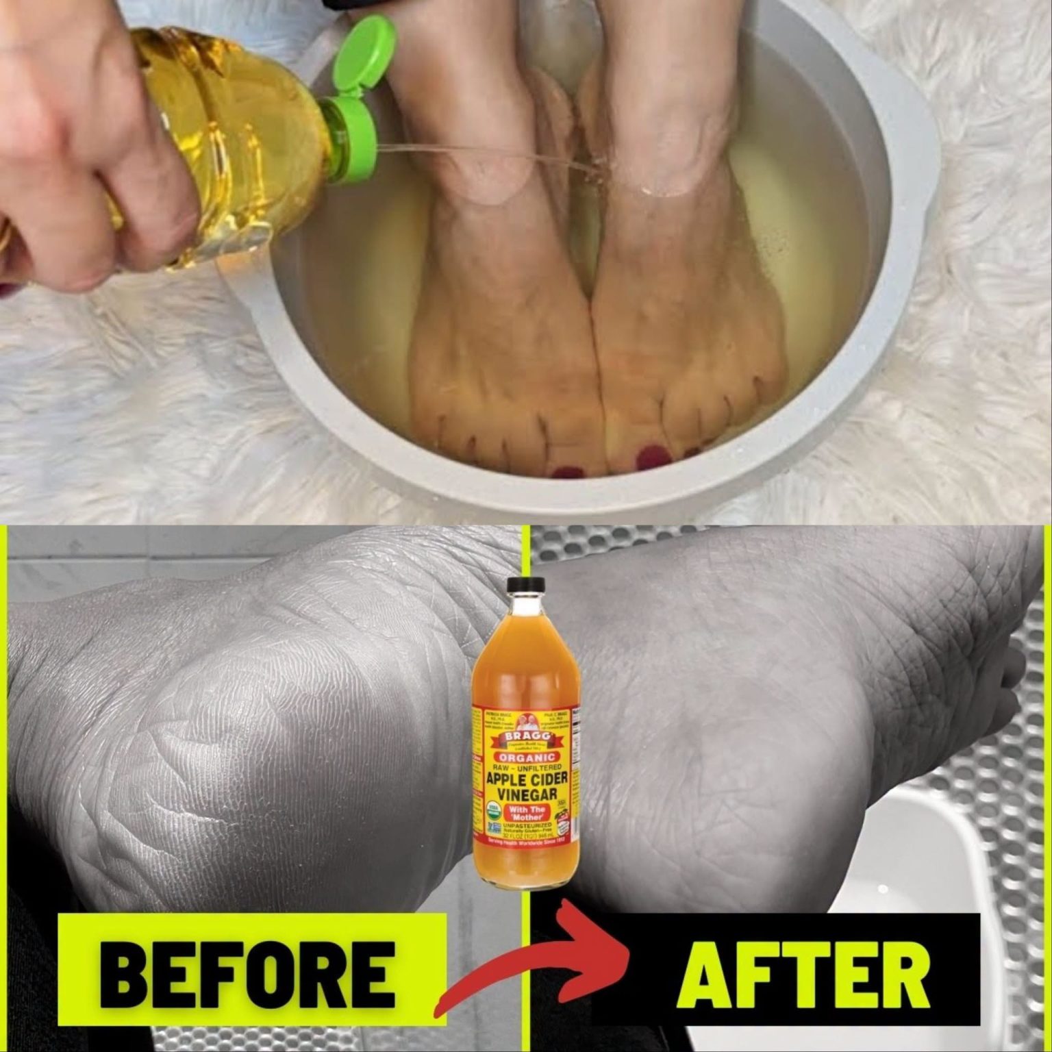 I soaked my feet in APPLE CIDER VINEGAR and 15 minutes later I was shocked at what happened !
