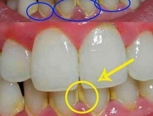 Remove dental plaque in 5 minutes naturally, without going to the dentist