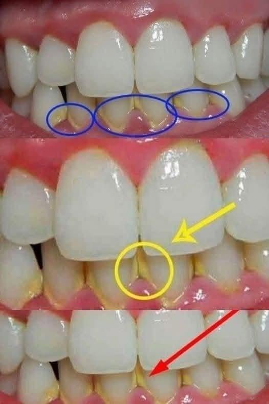 Remove dental plaque in 5 minutes naturally, without going to the dentist
