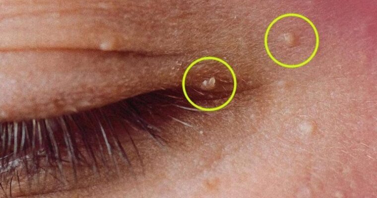 How to Get Rid of Milia: Those Annoying Fat Cysts