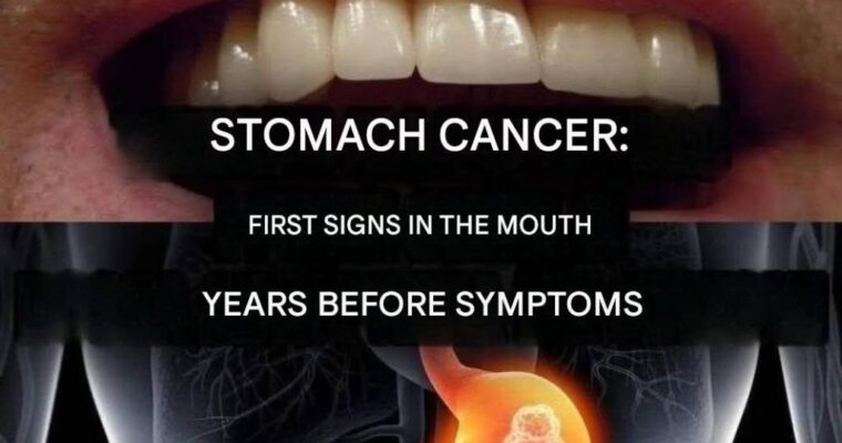 Stomach cancer: First signs in the mouth years before symptoms (1/2)