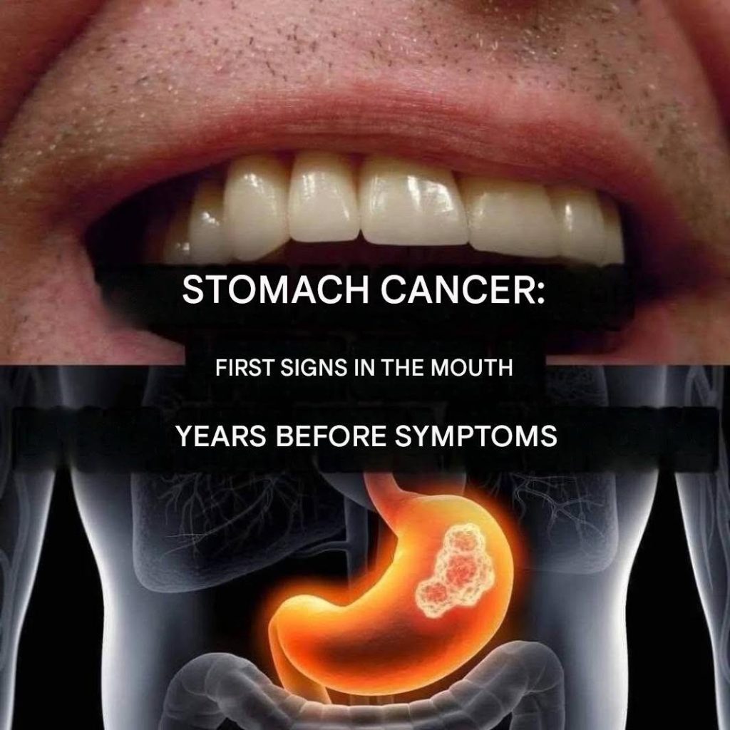 Stomach cancer: First signs in the mouth years before symptoms (1/2)