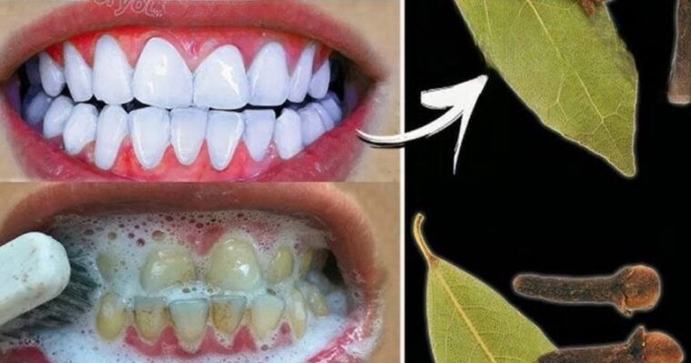 Natural Teeth Whitening with Bay Leaf Cloves