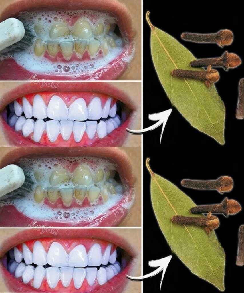 Natural Teeth Whitening with Bay Leaf Cloves